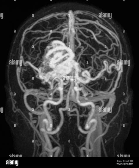 Brain Arteriovenous Malformation Avm Magnetic Resonance Angiography