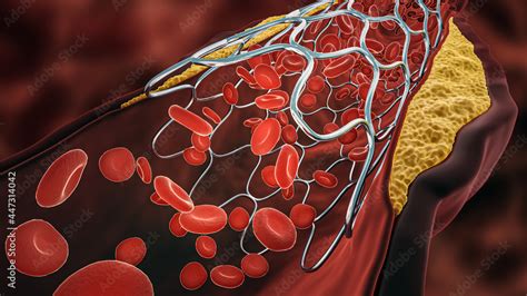 Angioplasty 3D Rendering Illustration Deployed Stent Within A Diseased