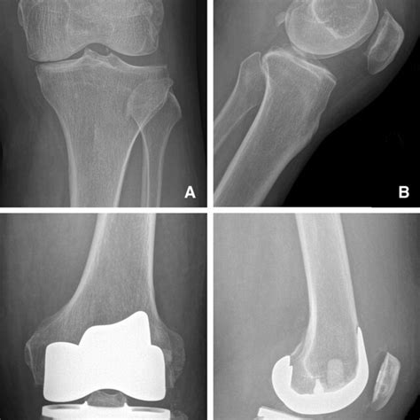 Pre And Post Operative Bicruciate Retaining Total Knee Arthroplasty