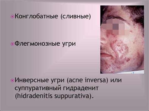 Угревая болезнь - online presentation