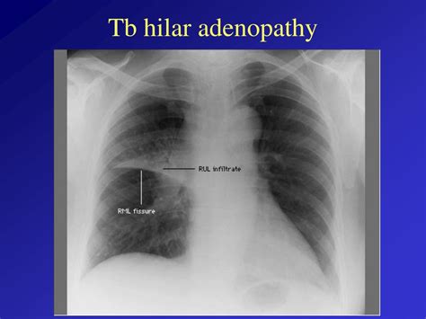 Ppt Tuberculosis Powerpoint Presentation Free Download Id 9657854