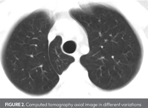 [pdf] Prevalence Of An Azygos Lobe Using Thoracic Computed Tomography