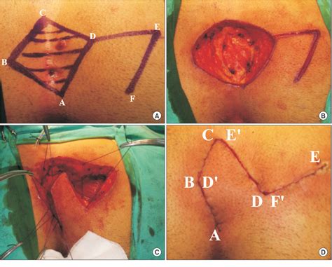 Figure 1 From Evaluation Of Intradermal Absorbable And Mattress Sutures