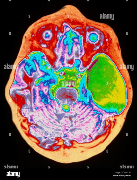 Irm Anormal Du Cerveau Ksyte Banque De Photographies Et Dimages