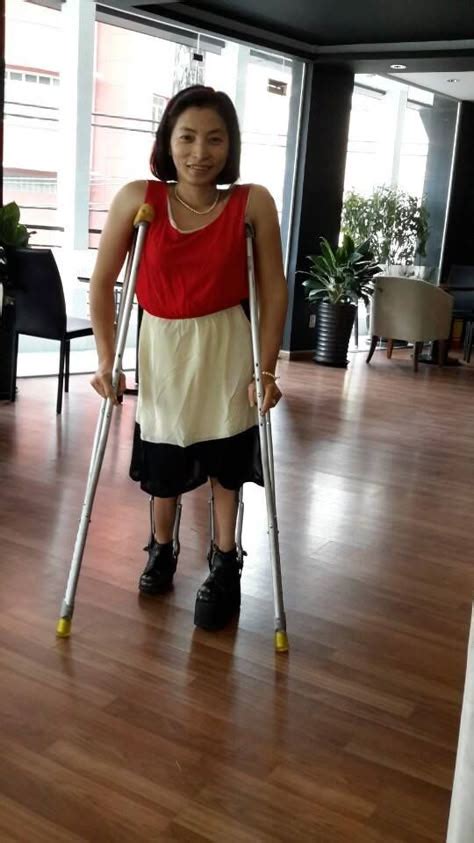 100 Leg Braces Ideas In 2020 Leg Braces Braces Braces Girls