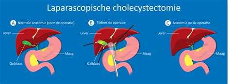 Cholecystectomie Folder Catharina Ziekenhuis