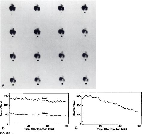 Figure From Comparison Of Technetium M Mibi And Thallium