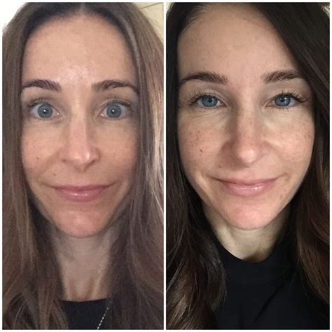 Botox For Droopy Eyelids Before And After