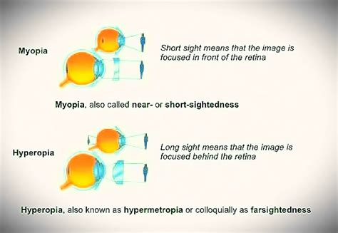 Hyperopia Definition Causes And Treatment Baybooks