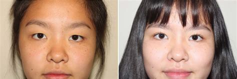 Asian Blepharoplasty In Vancouver Bc Dr Denton