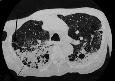 Exogenous Lipoid Pneumonia | Thoracic Key