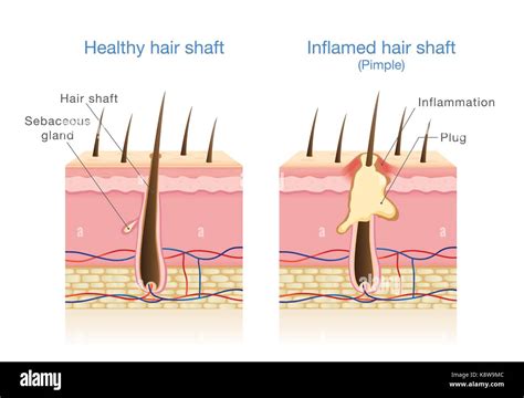 Clogged Hair Follicle Microscope