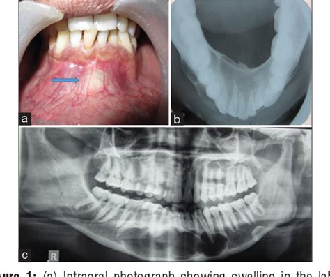 Figure From Calcifying Cystic Odontogenic Tumor Of Anterior Mandible