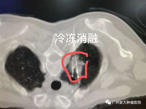 广州肿瘤医院：18cm的肺结节要怎么处理？冷冻消融效果佳 钢市纵横 新闻中心中钢网