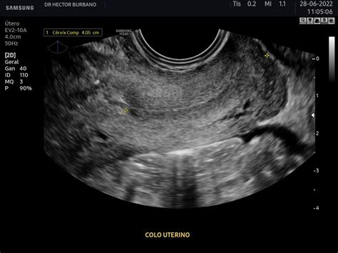 Avalia O Transvaginal Do Comprimento Do Colo Uterino Medfem