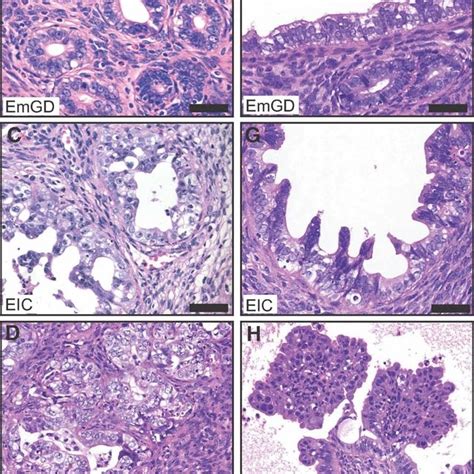 Precursor Lesions And Progression Model Of Tumour Formationanormal