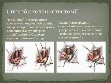 Гострий холецистит - презентация онлайн