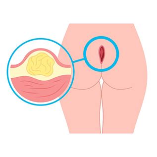 Cirurgia A Laser Para Cisto Pilonidal Dra Andrea Pecci