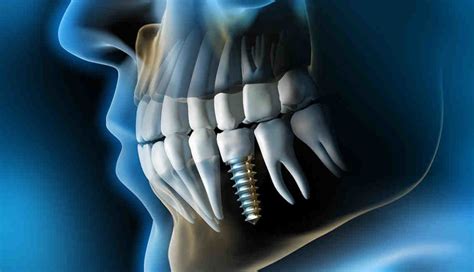 Will It Hurt If My Dental Implant Screw Fell Out Dental News Network