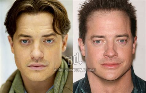 Brendan Fraser Hair Loss