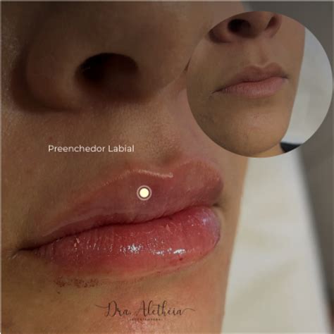 Preenchimento Labial Com ácido Hialurônico 1ml Dra Aletheia