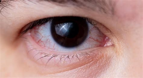 Premium Photo The Eye With Swollen Capillaries Is Close