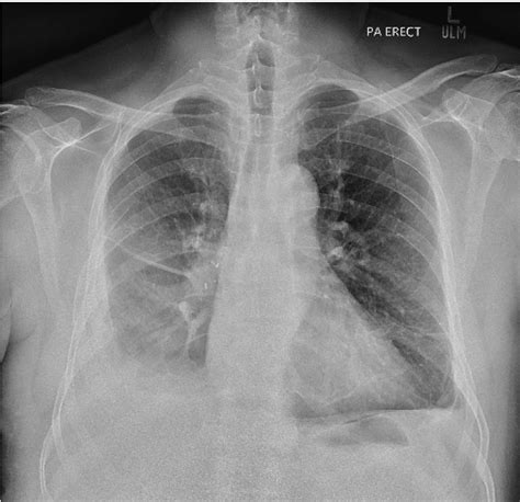 Erect Chest Xray PA View Done In Follow Up Showing Right Sided