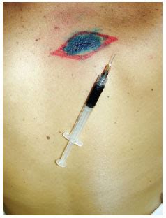 Rbcp Sentinel Lymph Node Evaluation In The Treatment Of Cutaneous