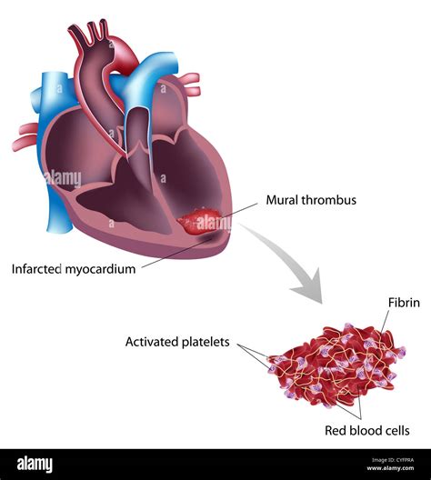 Rivaroxaban For Lv Thrombus | semashow.com