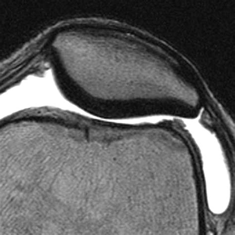 Articular Cartilage In The Knee Current Mr Imaging Techniques And