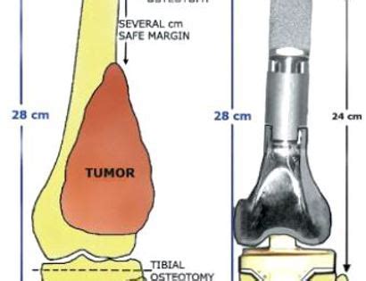 Distal Femur Tumor Prosthesis Replacement