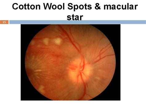 Cotton Wool Spots Symptoms - Several Cotton Wool Spots Typical Of Hiv ...