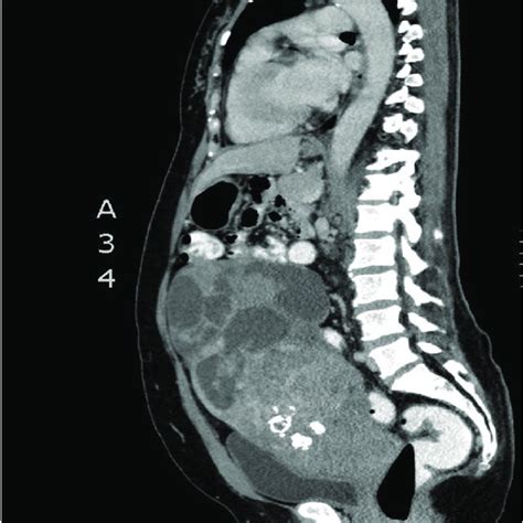 Pelvic Mri Showing A Huge Uterine Mass And A Left Adnexal Complex Cyst Download Scientific