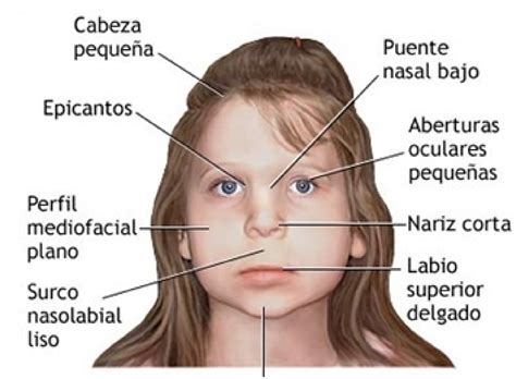 S Ndrome De Rett Nepsa Rehabilitaci N Neurol Gica