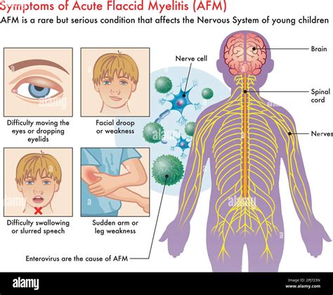 Malattia Respiratoria Acuta Improvvisa Immagini Vettoriali Stock Alamy