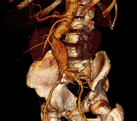 Chirurgie Vasculaire POLYCLINIQUE BEZANNES anévrysmes aorte