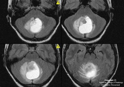 Neuroradiology On the Net: Juvenile pilocytic astrocytoma