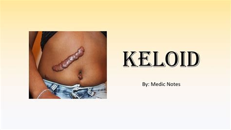 Keloid Clinical Features Keloid Vs Hypertrophic Scar Treatment