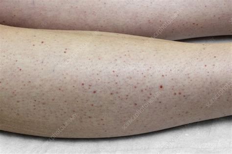 Henoch-Schonlein purpura rash - Stock Image C021/5600 - Science Photo ...