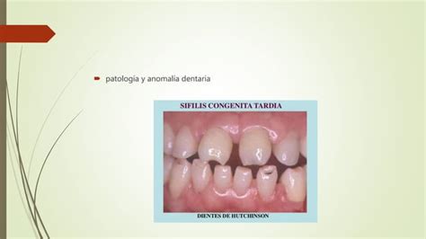 Mordida Abierta Ppt