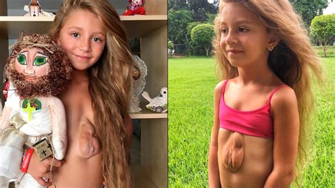 El Impactante Caso De La Niña Que Nació Con El Corazón Fuera Del Pecho Y Cuenta Su Historia En