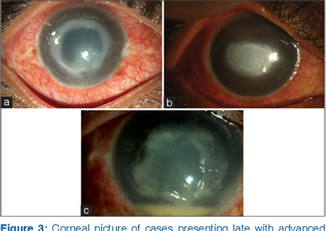 Non Contact Lens Related Acanthamoeba Keratitis Semantic Scholar