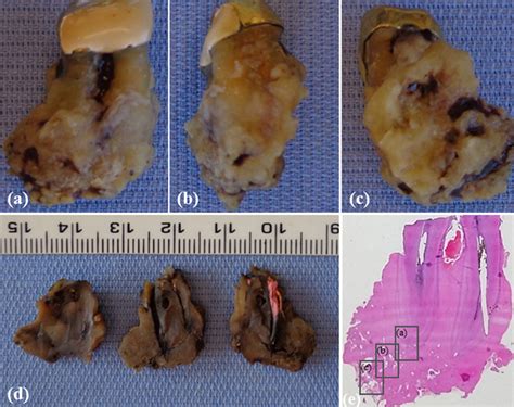 Scielo Brasil Exuberant Hypercementosis Mimicking Cementoblastoma