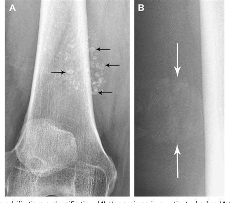 Figure 11 From The Evolution Of Musculoskeletal Tumor Imaging Semantic Scholar