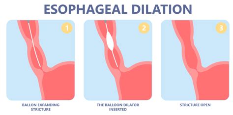 How Is Eosinophilic Esophagitis Treated Eoe Restore Patient And Caregiver