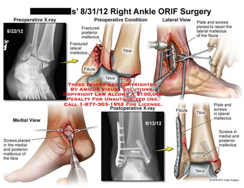 Amicus Illustration Of Amicus Surgery Ankle Fibula Tibia Talus