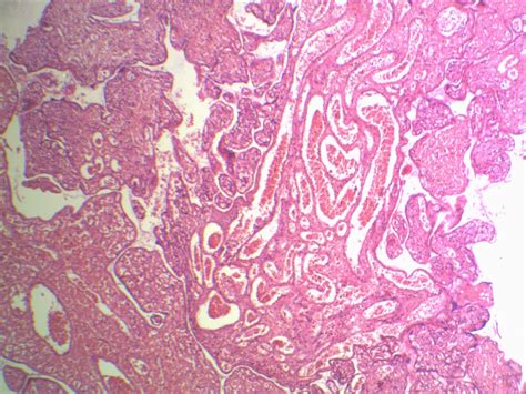 Pathology Outlines Mesenchymal Dysplasia