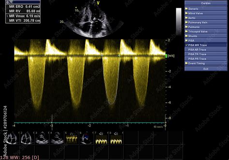 Screen of echocardiography (ultrasound) machine. Stock Photo | Adobe Stock