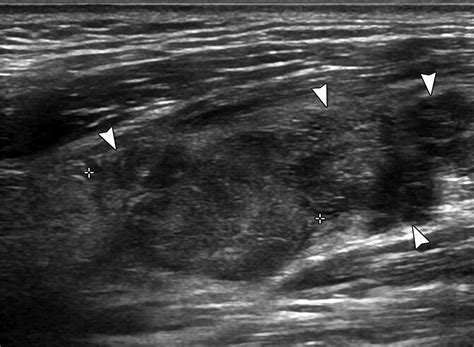 Cervical Lymph Node Imaging Reporting And Data System For Ultrasound Of Cervical Lymphadenopathy