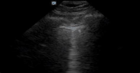 POCUS Made Easy Lung LITFL Ultrasound Library